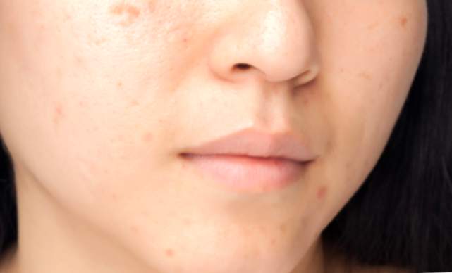 Lernen Sie, auf Ihre Haut zu achten, um das Auftreten von Akne-Flecken zu verhindern