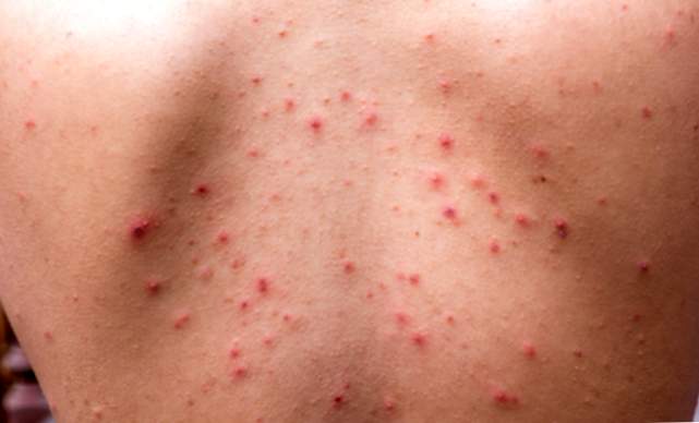 Die Auswirkungen von Akne vulgaris auf die Haut